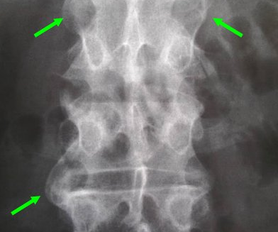 Artrita articulațiilor coloanei vertebrale